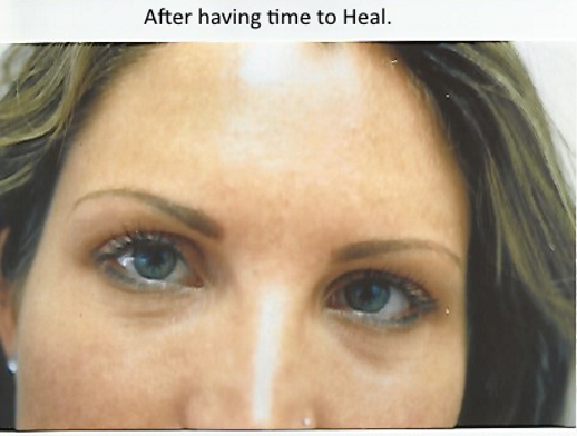 Example 2 After Healing